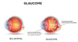 glaucome symptômes