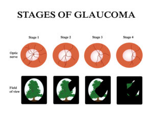 glaucome