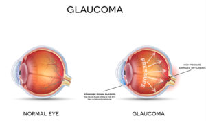 glaucome