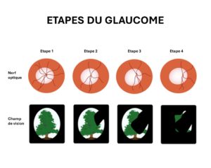 glaucome étapes